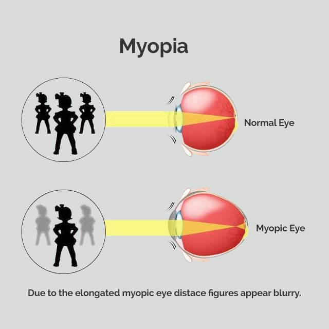 myopia müoopia
